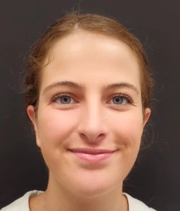 Rhinoplasty-and-Chin-Implant-Case--381 | After Rhinoplasty 1