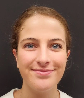 Rhinoplasty-and-Chin-Implant-Case--381 | After Rhinoplasty 1