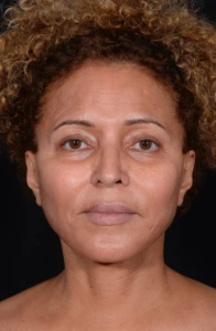 Facelift-Case--360 | After Facelift 1