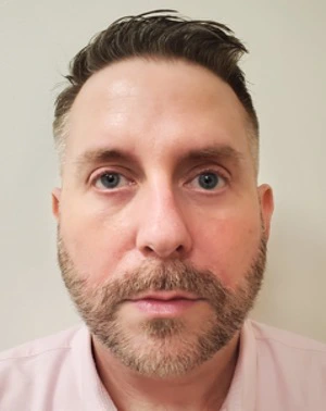 Lower-Blepharoplasty-Case--359 | After Eyelid Surgery 1