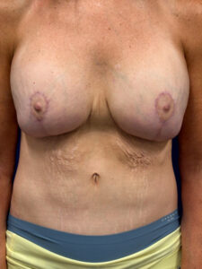 Augmentation-Mastopexy-Case--3055 | After Breast Augmentation With Lift 1