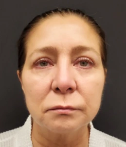 Quad-Blepharoplasty-Case--358 | After Eyelid Surgery 1