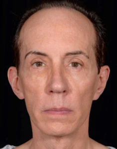 Quad-Blepharoplasty-Case--357 | After Eyelid Surgery 1