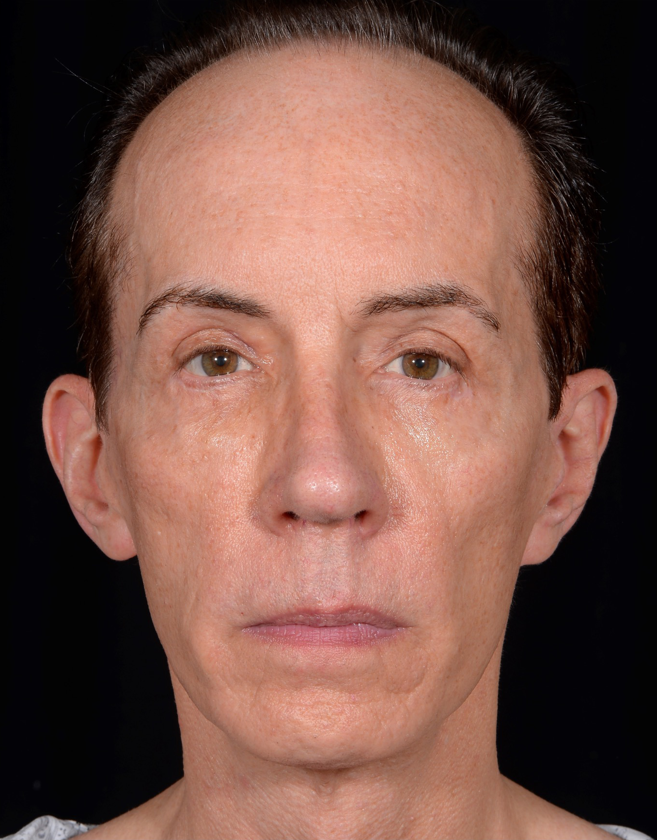 Quad-Blepharoplasty-Case--357 | After Eyelid Surgery 1