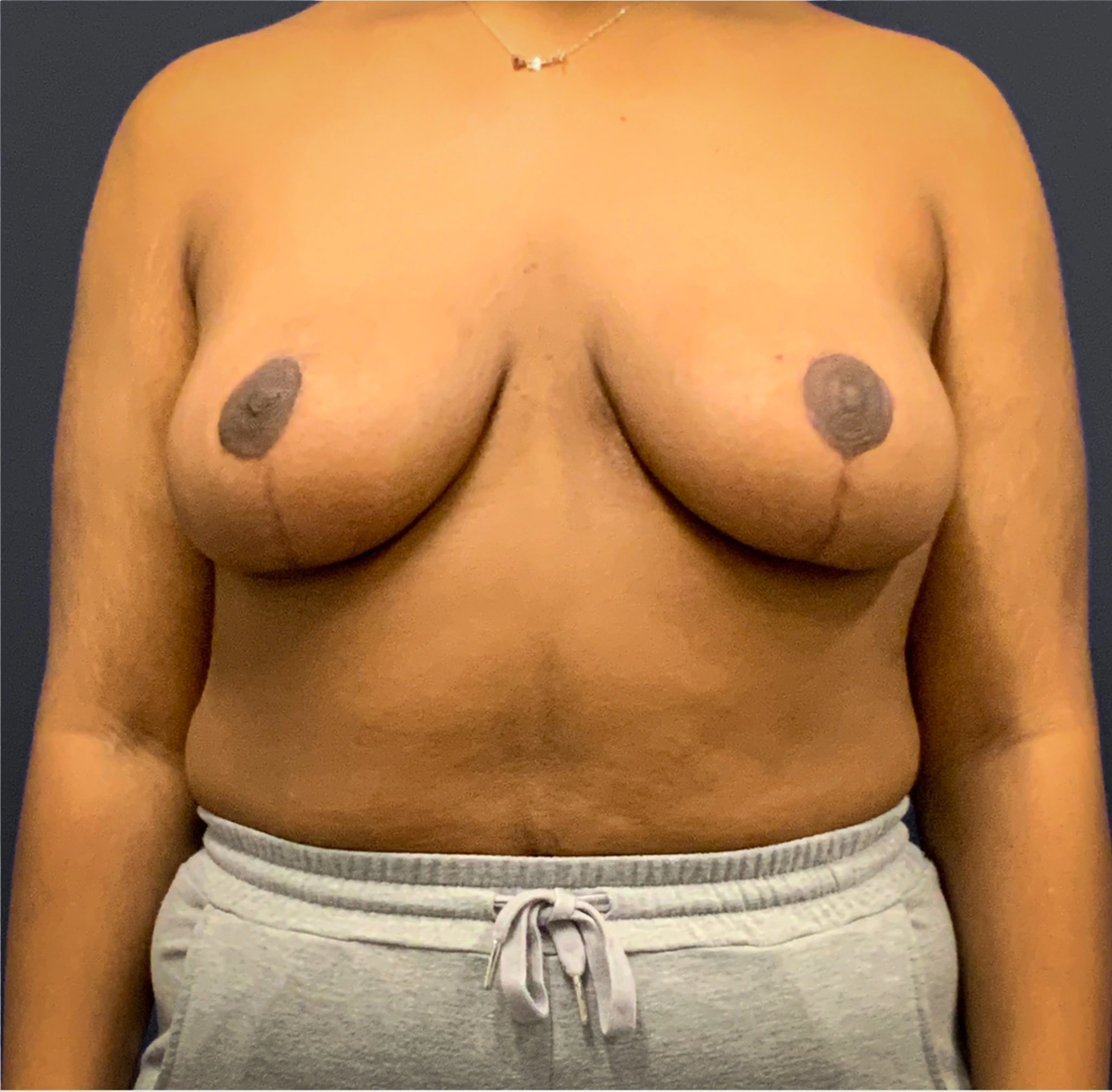 Breast-Reduction-Case--5320 | After Breast Reduction 1