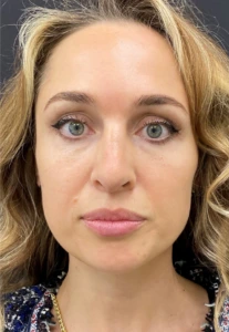 Rhinoplasty-Case--378 | After Rhinoplasty 1