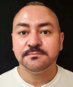 Liposuction-Case--368 | After Submental Liposuction 1