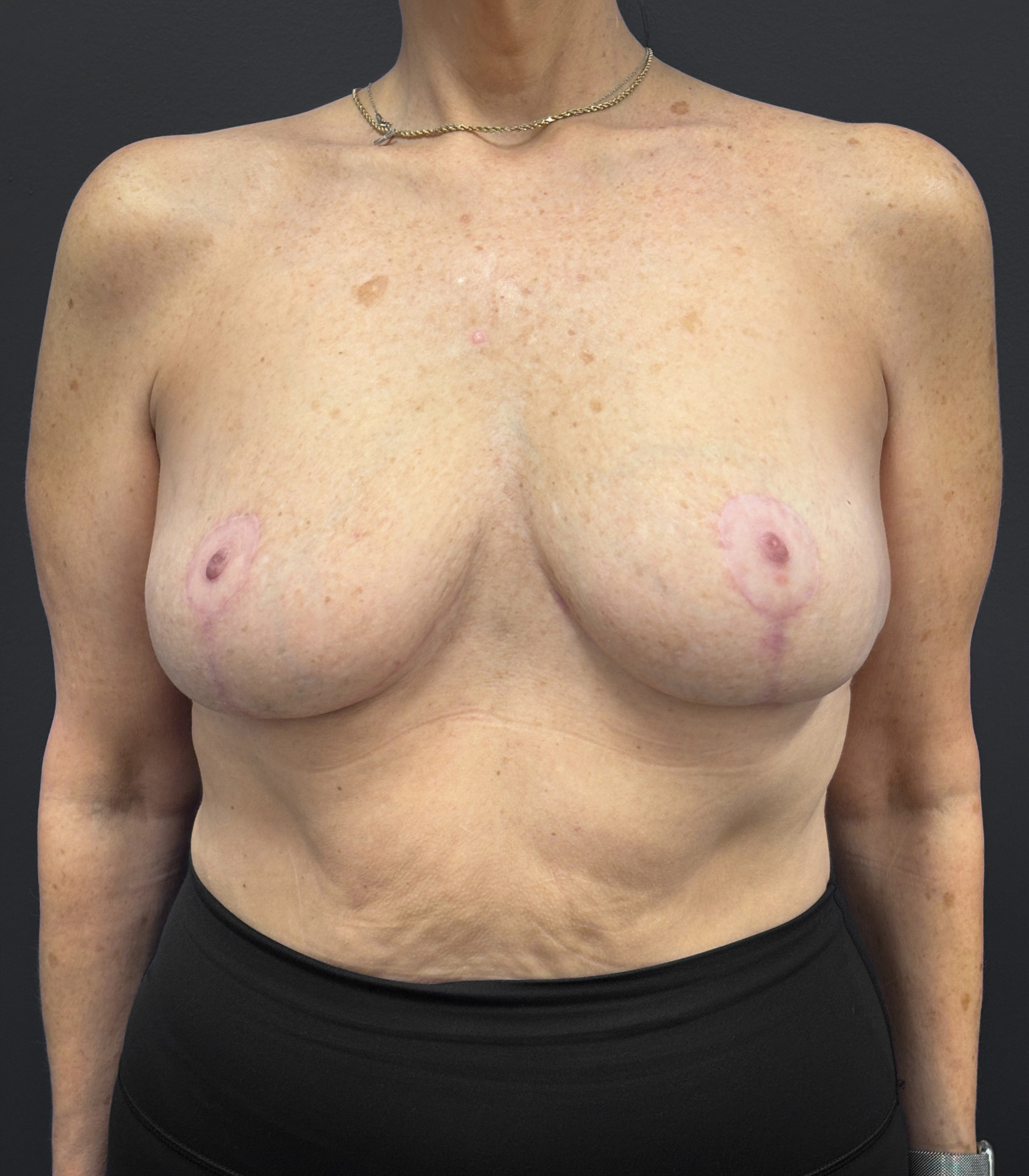 Breast-Reduction-Case--2538 | After Breast Reduction 1