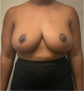 Breast-Reduction-Case--2564 | After Dr. Arjun Kanuri 1