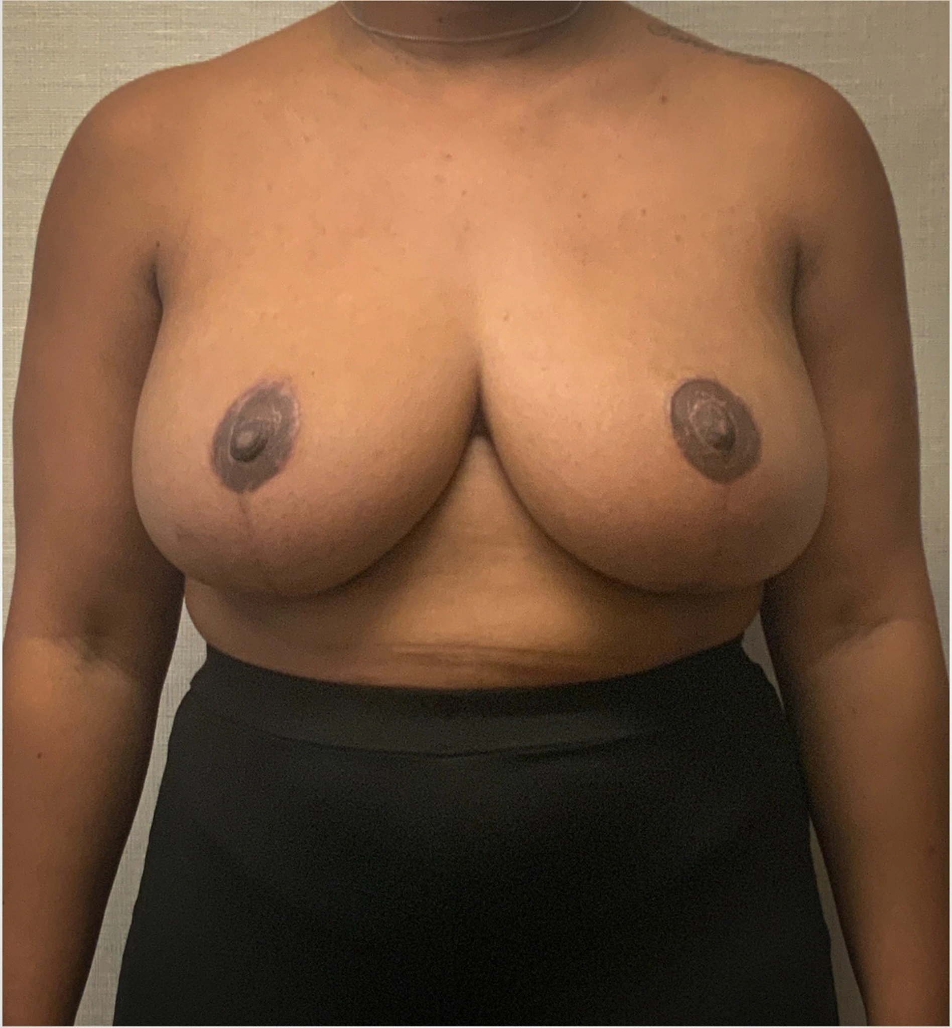 Breast-Reduction-Case--2564 | After Breast Reduction 1