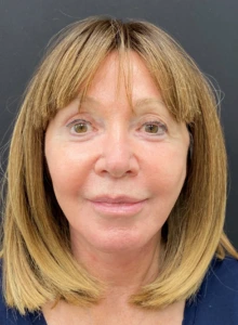 Facelift-Case--365 | After Facelift 1