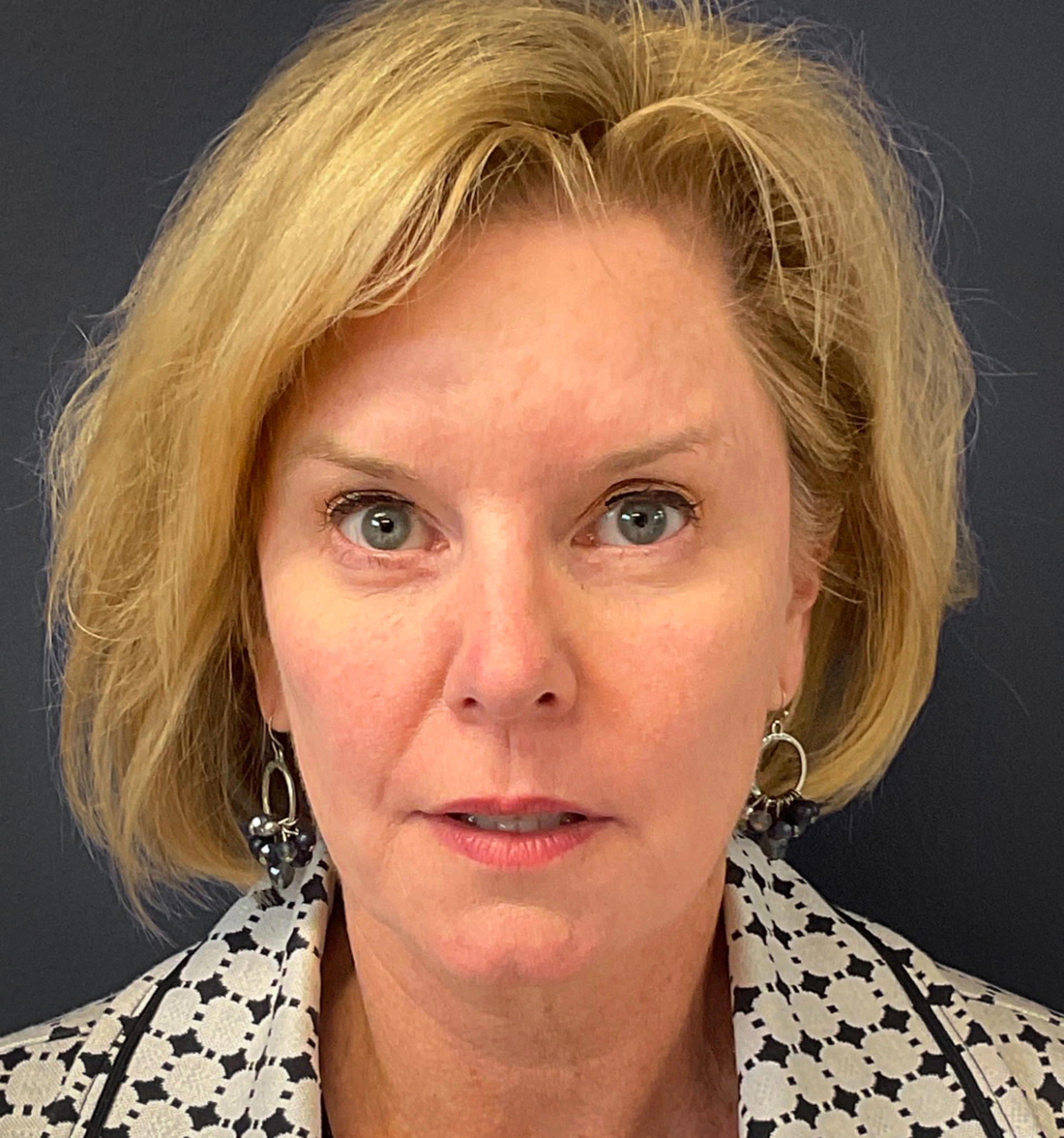 Blepharoplasty-Case--7015 | After Eyelid Surgery 4