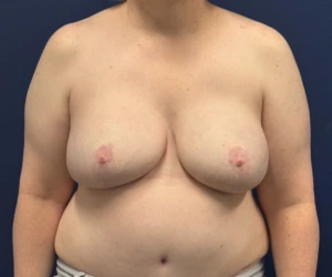 Breast-Reconstruction-DIEP-Flap-Case--26029 | After DIEP Flap 1