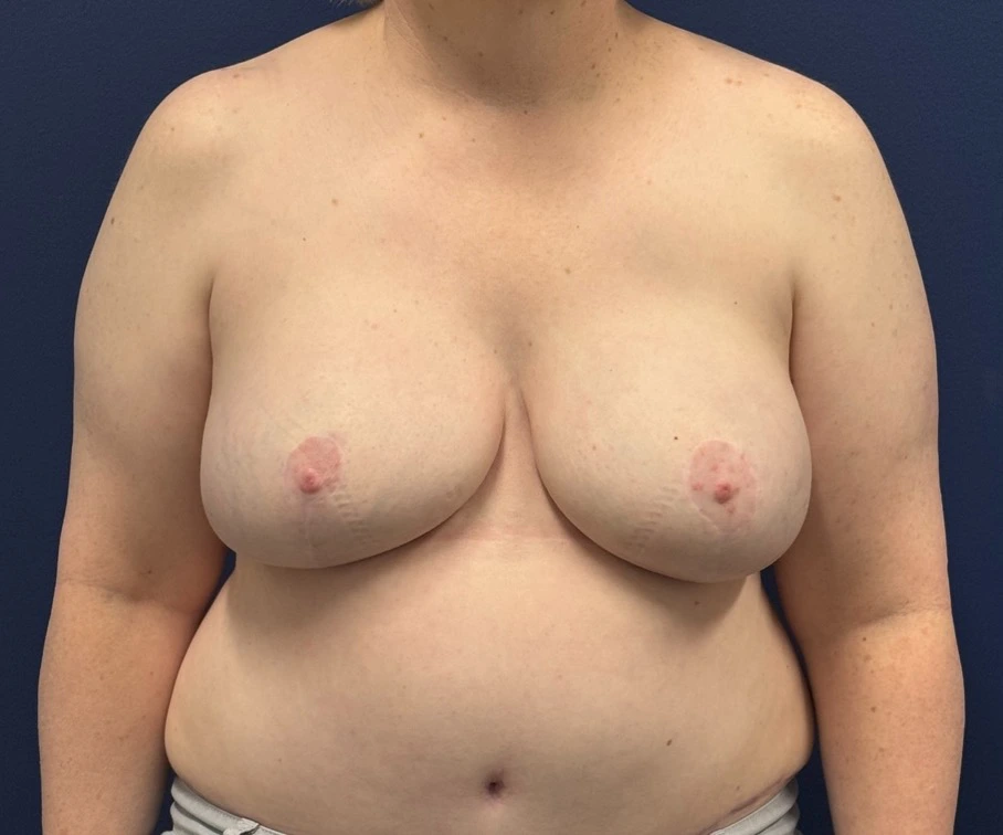 Breast-Reconstruction-DIEP-Flap-Case--26029 | After Breast Reconstruction 1