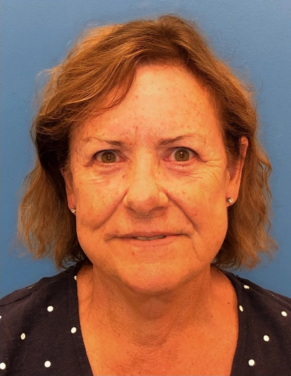 Facelift-Case--14406 | After Eyelid Surgery 1