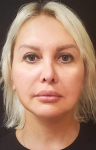 Facelift-Case--362 | After Facelift 1