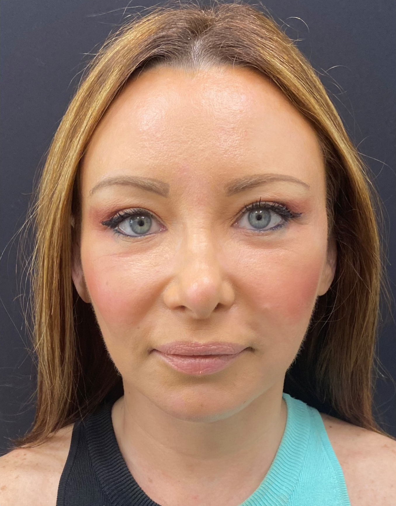 Facelift-Case--355 | After Facelift 1