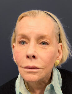 Facelift-Case--7247 | After Facelift 1