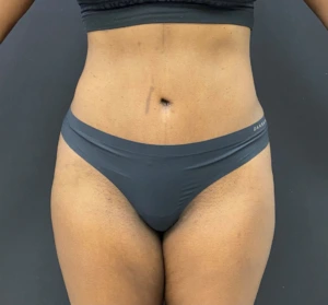 Abdominoplasty-Case--340 | After Tummy Tuck 1