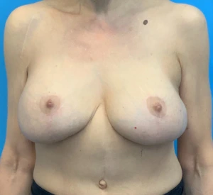 Breast-Augmentation-Mastopexy-Case--24958 | After Revision Augmentation 1
