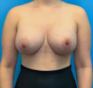 Breast-Augmentation-Case--23631 | After Breast Augmentation 1
