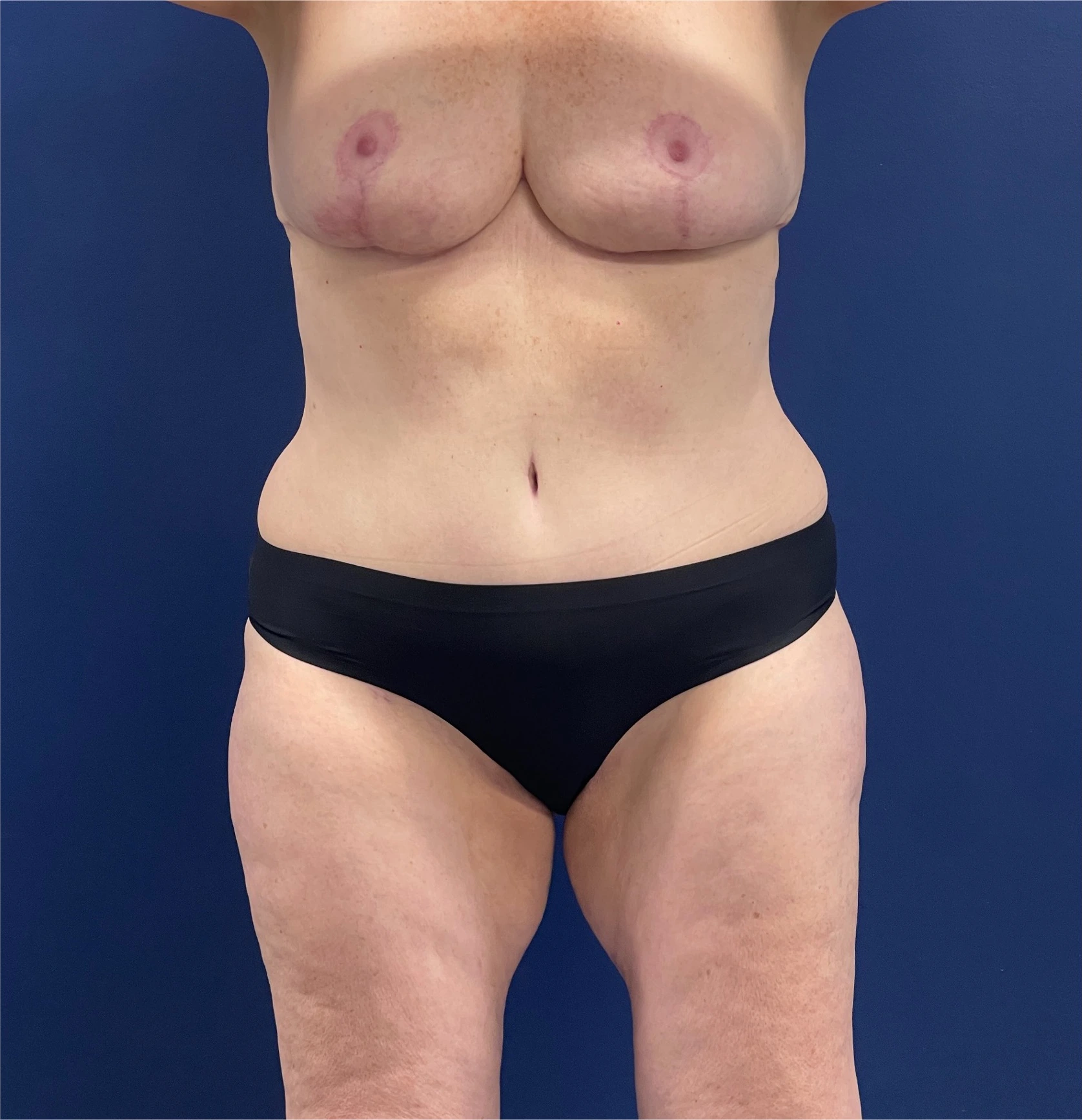 Mommy-Makeover-Case--26853 | After Mommy Makeover 1