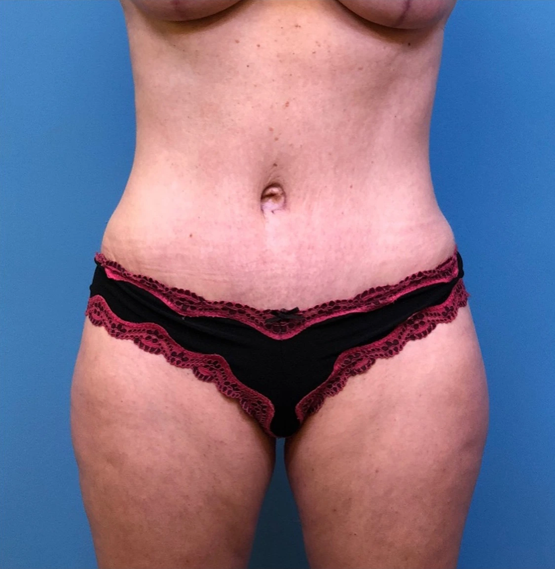 Abdominoplasty-Flank-Liposuction-Case--244 | After Liposuction 1