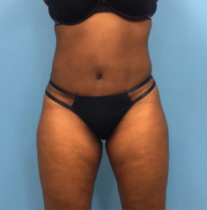 Case--246 | After Liposuction 1