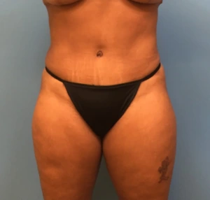 Case--247 | After Liposuction 1