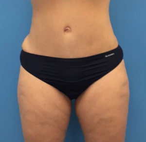 Case--248 | After Liposuction 1