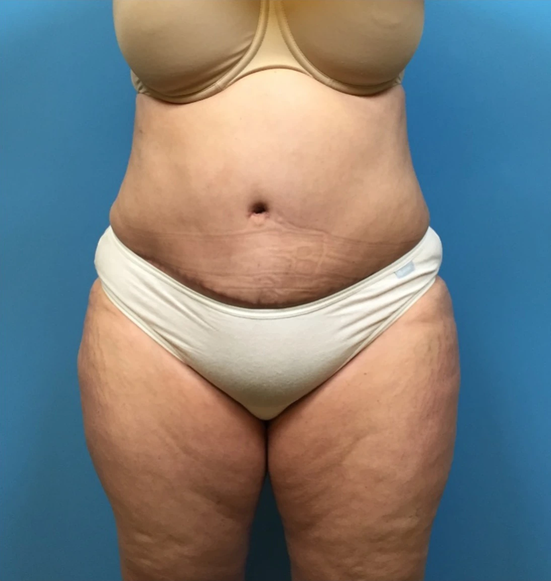 Case--249 | After Liposuction 1