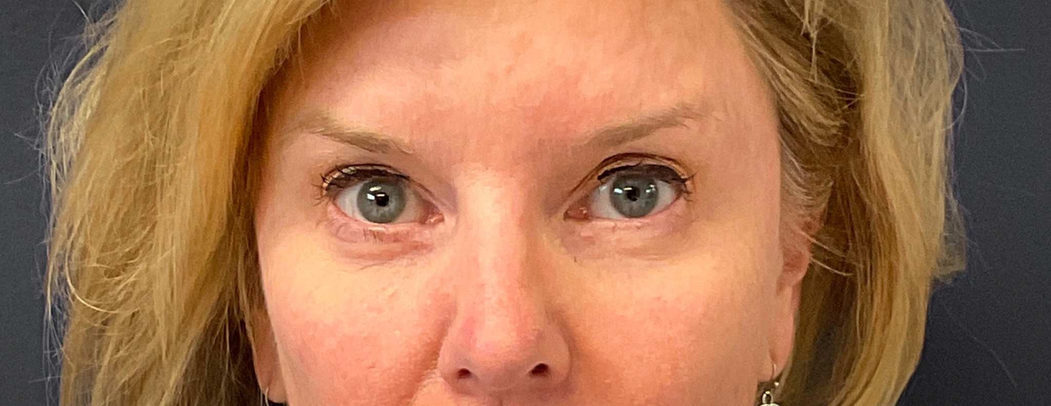 Blepharoplasty-Case--7015 | After Eyelid Surgery 1