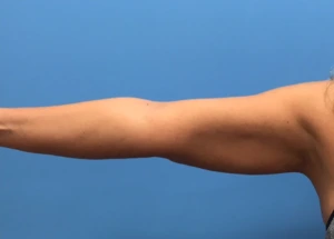 Case--280 | After Liposuction 1