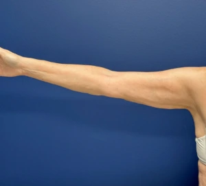 Liposuction-Case--23690-2 | After Liposuction 2