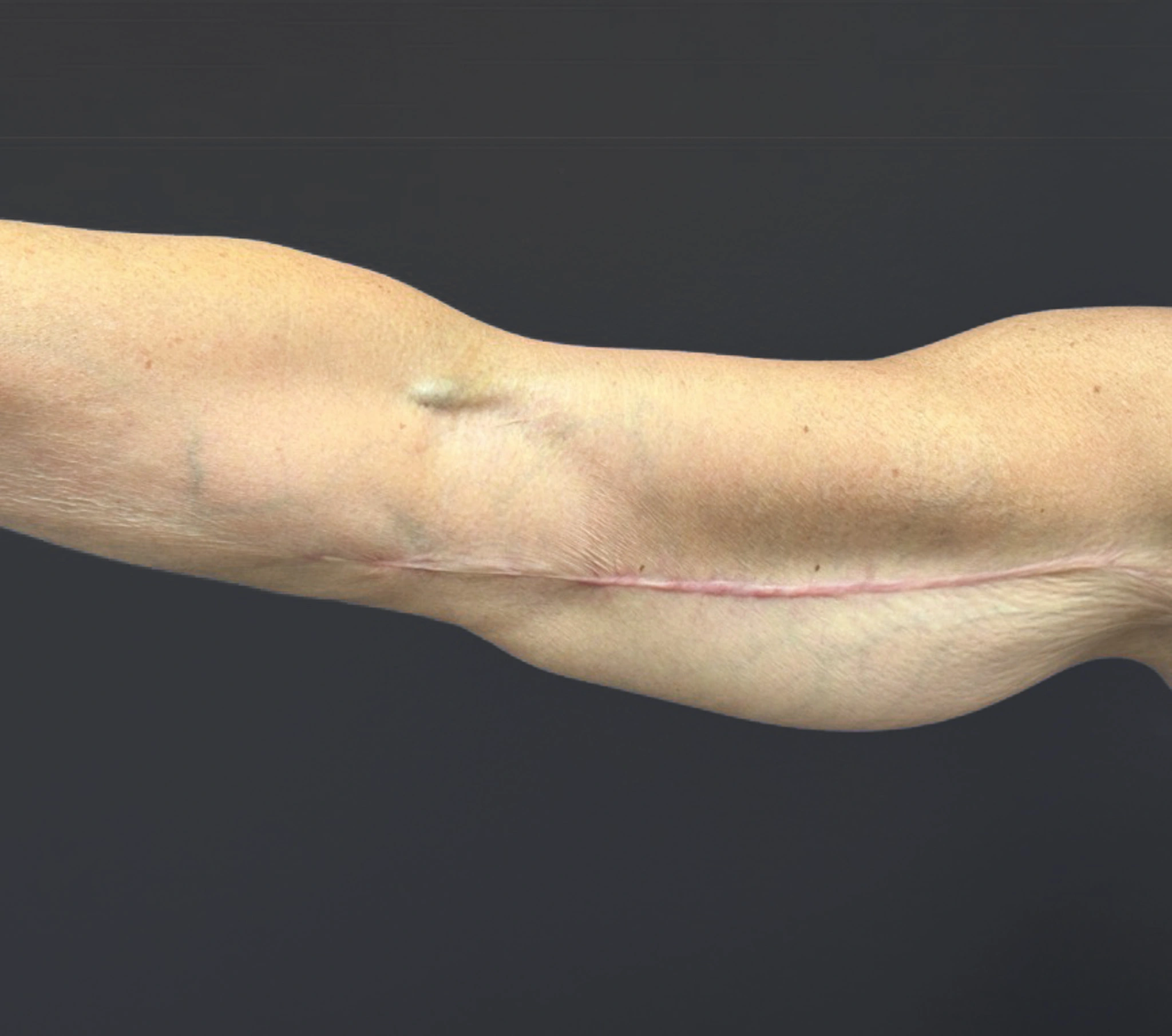 Brachioplasty-Case--6382 | After Arm Lift 6