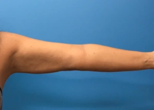 Case--280 | After Liposuction 2