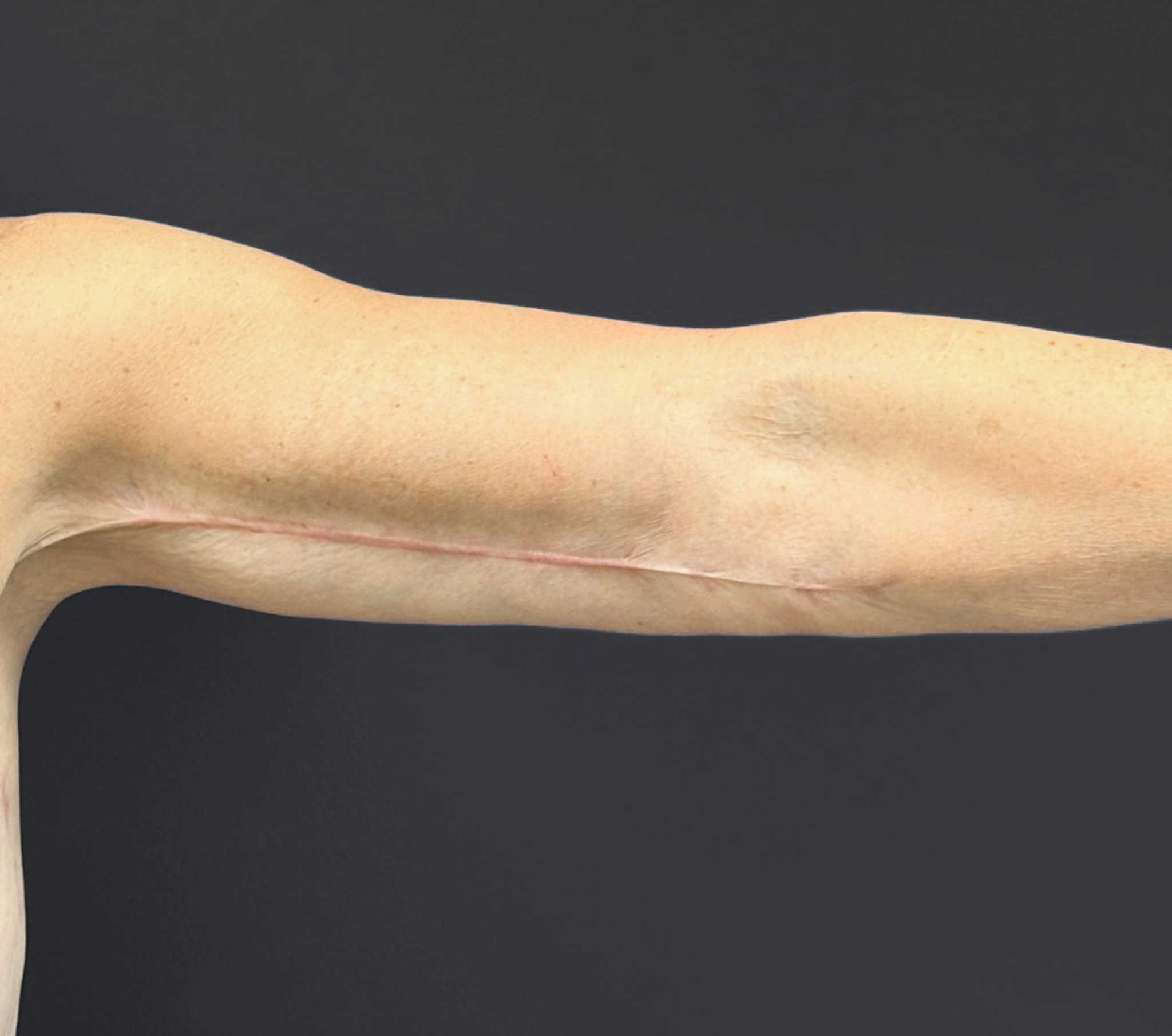 Brachioplasty-Case--6382 | After Arm Lift 5