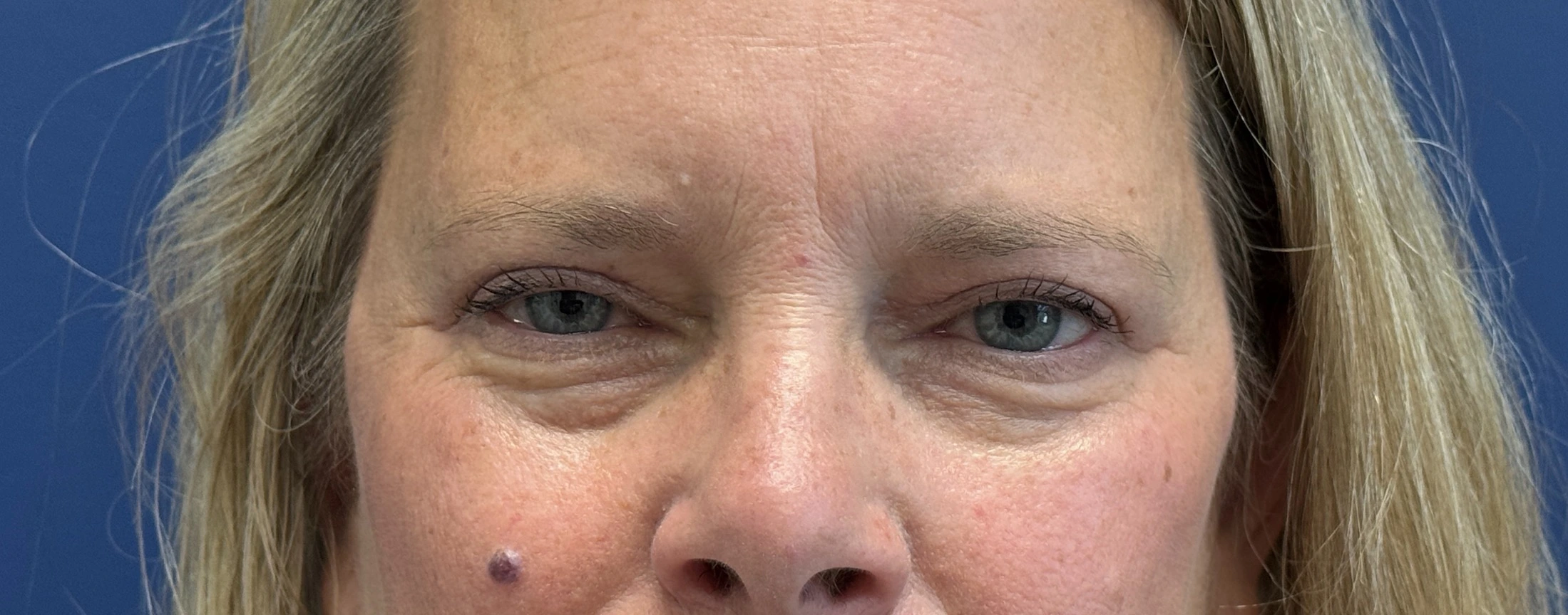 Blepharoplasty-Case--13622 | After Eyelid Surgery 2