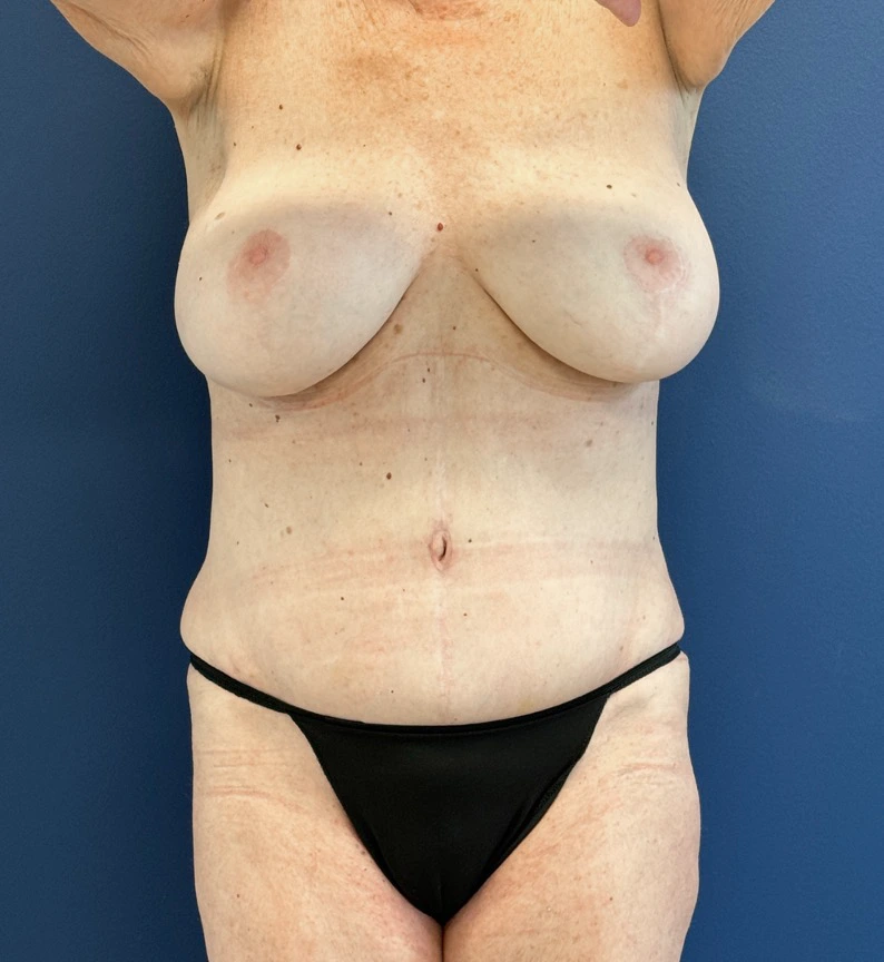 Lipoabdominoplasty-Case--27935 | After Liposuction 2
