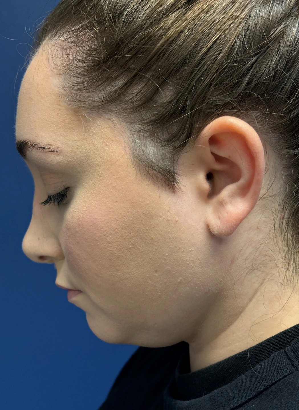 Submental-Liposuction-Case--29107 | After Submental Liposuction 4