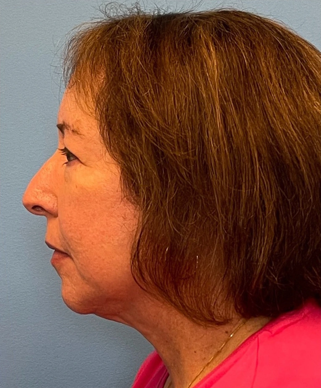 Facelift-Case--21241 | After Facelift 3