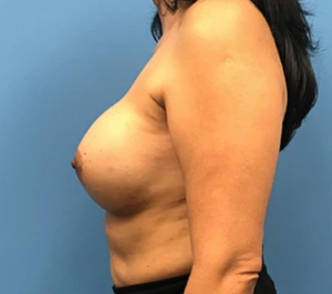 Case--134 | After Dr. Samir Rao 2