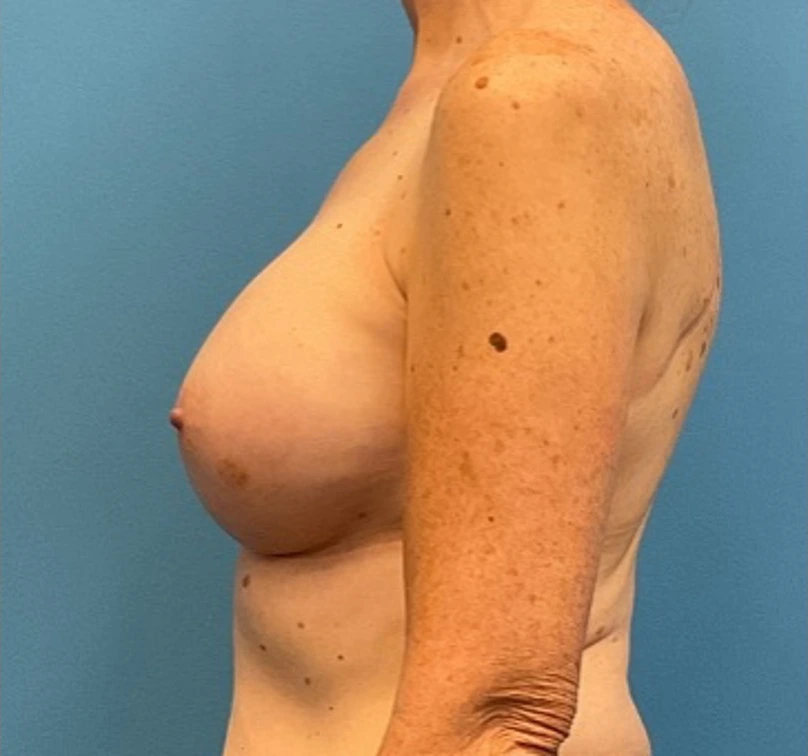 Breast-Augmentation-Case--27374 | After Breast Augmentation 3
