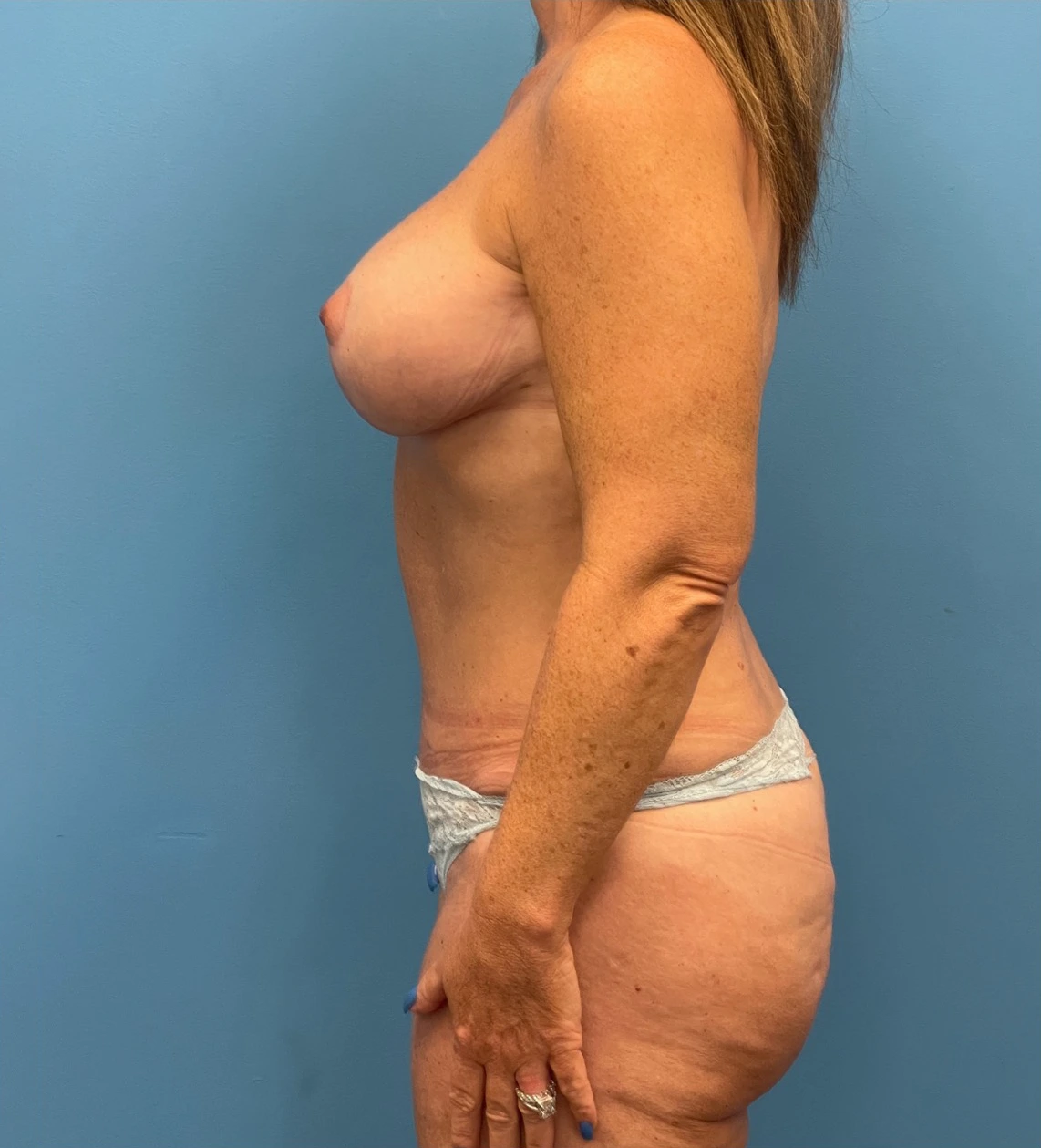 Mommy-Makeover-Case--11775 | After Mommy Makeover 2