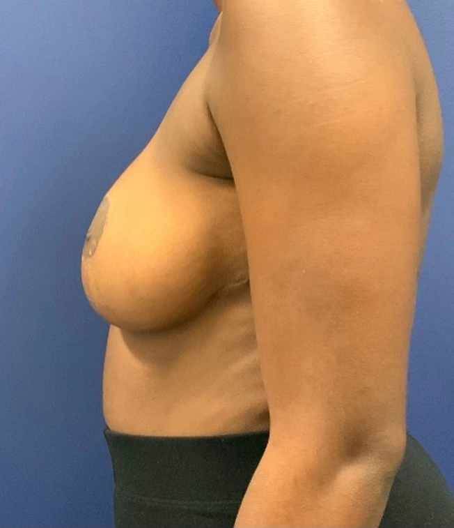 Breast-Reduction-Case--27254 | After Breast Reduction 2