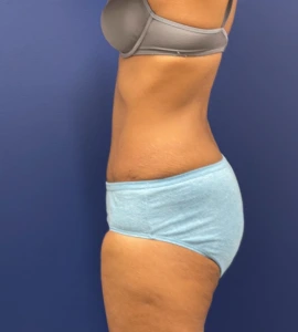 Abdominoplasty-Case--24922 | After Liposuction 2