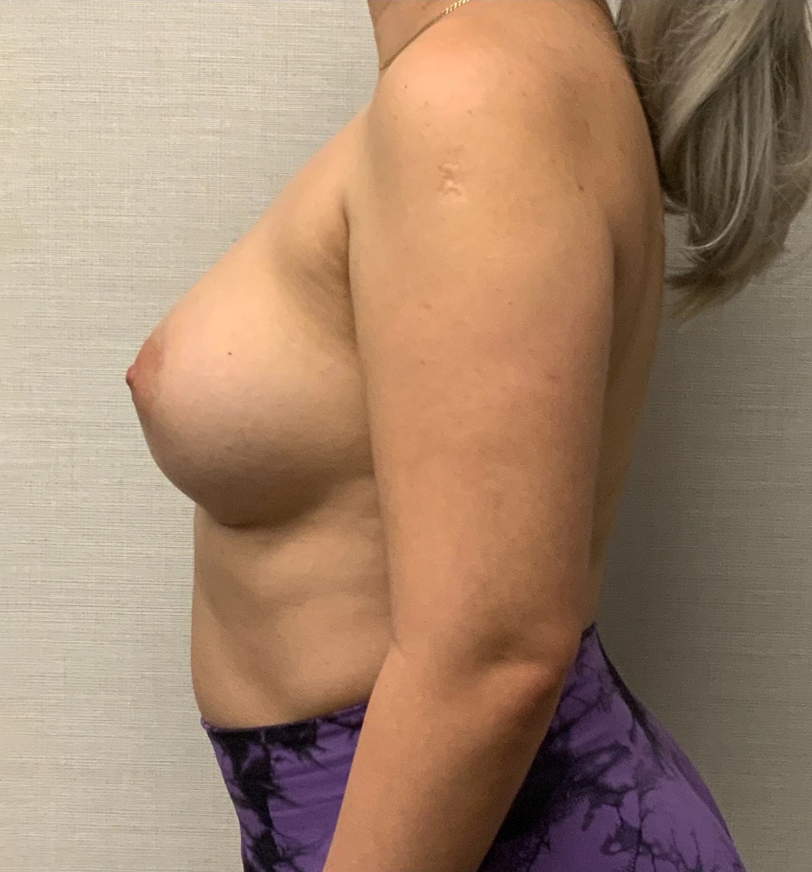 Breast-Augmentation-Case--25743 | After Breast Augmentation 3