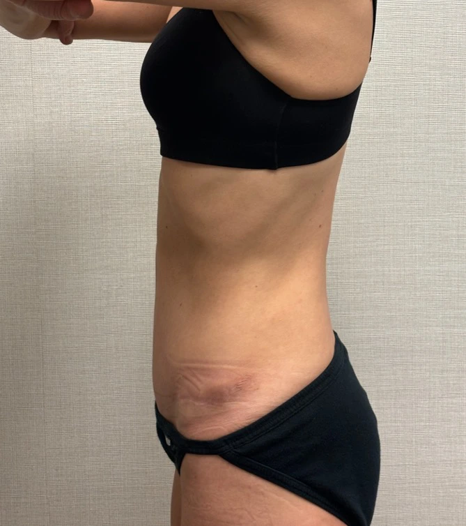 Revision-Tummy-Tuck-Case--23643 | After Tummy Tuck 3