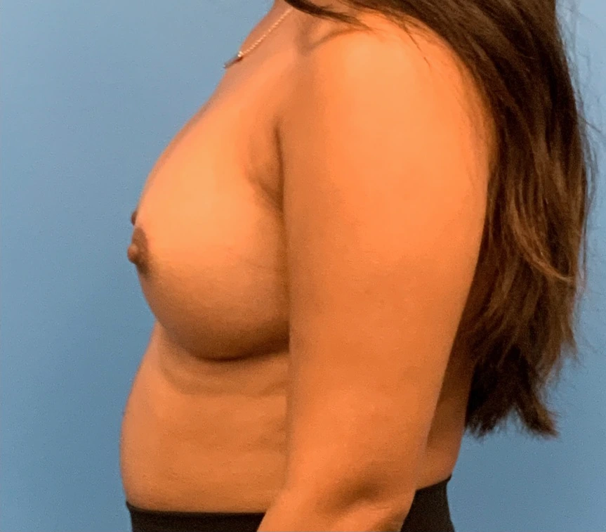 Breast-Augmentation-Case--23834 | After Breast Augmentation 3
