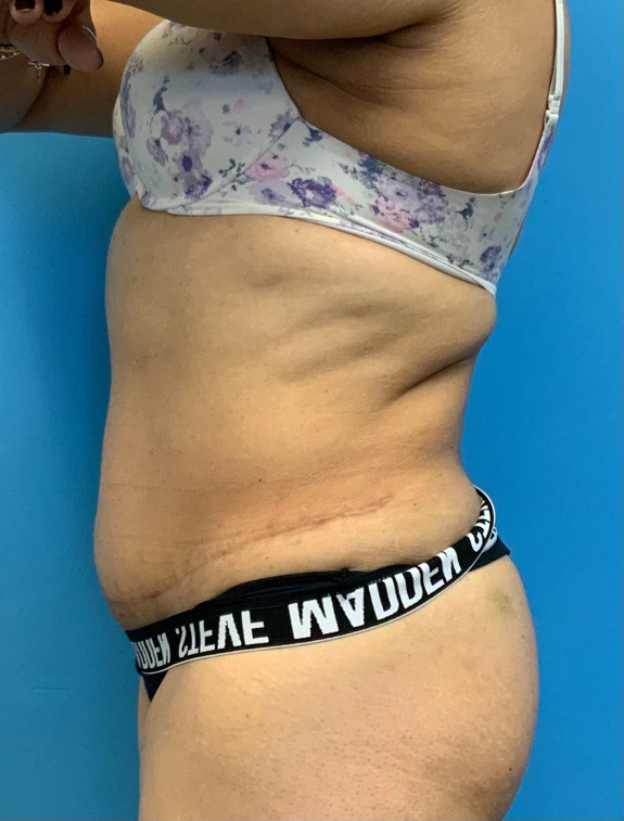 Tummy-Tuck-Case--25988 | After Tummy Tuck 3